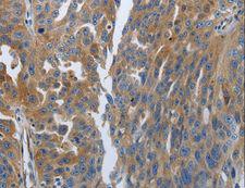 SOCS1 Antibody - Immunohistochemistry of paraffin-embedded Human ovarian cancer using SOCS1 Polyclonal Antibody at dilution of 1:70.