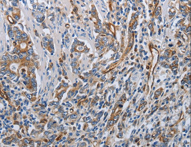 SOCS1 Antibody - Immunohistochemistry of paraffin-embedded Human gastric cancer using SOCS1 Polyclonal Antibody at dilution of 1:70.