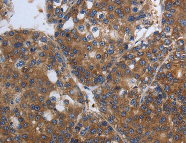 SOCS1 Antibody - Immunohistochemistry of paraffin-embedded Human liver cancer using SOCS1 Polyclonal Antibody at dilution of 1:90.