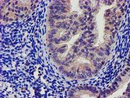 SOCS3 Antibody - IHC of paraffin-embedded Adenocarcinoma of Human endometrium tissue using anti-SOCS3 mouse monoclonal antibody.