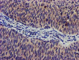 SOCS3 Antibody - IHC of paraffin-embedded Carcinoma of Human bladder tissue using anti-SOCS3 mouse monoclonal antibody.