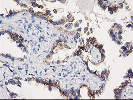 SOCS3 Antibody - IHC of paraffin-embedded Carcinoma of Human thyroid tissue using anti-SOCS3 mouse monoclonal antibody.