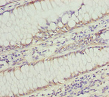 SOCS4 Antibody - Immunohistochemistry of paraffin-embedded human colon cancer at dilution 1:100