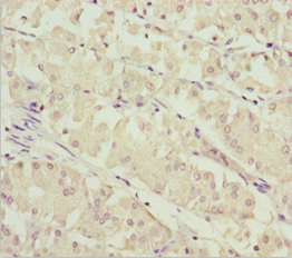 SOCS4 Antibody - Immunohistochemistry of paraffin-embedded human gastric cancer at dilution 1:100