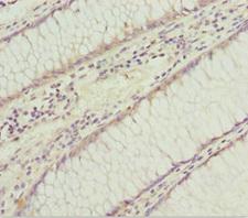 SOCS4 Antibody - Immunohistochemistry of paraffin-embedded human colon cancer at dilution 1:100