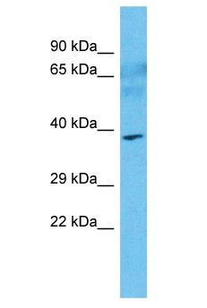 SOCS7 / SOCS-7 Antibody - SOCS7 / SOCS-7 antibody Western Blot of Breast Tumor. Antibody dilution: 1 ug/ml.  This image was taken for the unconjugated form of this product. Other forms have not been tested.