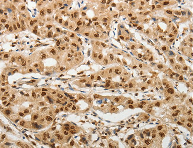 SOCS7 / SOCS-7 Antibody - Immunohistochemistry of paraffin-embedded Human lung cancer using SOCS7 Polyclonal Antibody at dilution of 1:30.