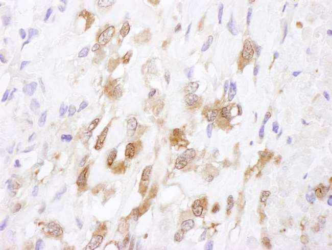 SOD1 / Cu-Zn SOD Antibody - Detection of Human SOD1 by Immunohistochemistry. Sample: FFPE section of human osteosarcoma. Antibody: Affinity purified rabbit anti-SOD1 used at a dilution of 1:1000 (1 ug/ml). Detection: DAB.