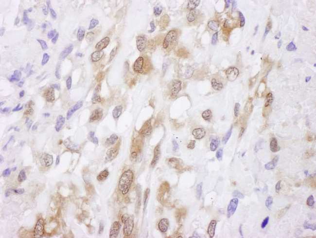 SOD1 / Cu-Zn SOD Antibody - Detection of Human SOD1 by Immunohistochemistry. Sample: FFPE section of human osteosarcoma. Antibody: Affinity purified rabbit anti-SOD1 used at a dilution of 1:5000 (0.2 ug/ml). Detection: DAB.