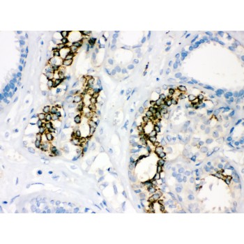 SOD2 / Mn SOD Antibody - SOD2 antibody IHC-paraffin. IHC(P): Human Mammary Cancer Tissue.