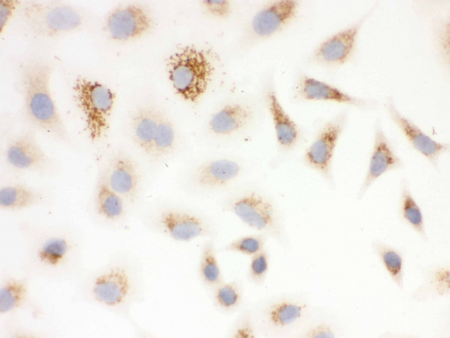 SOD2 / Mn SOD Antibody - IHC analysis of SOD2 using anti-SOD2 antibody. SOD2 was detected in immunocytochemical section of A549 cell. Heat mediated antigen retrieval was performed in citrate buffer (pH6, epitope retrieval solution) for 20 mins. The tissue section was blocked with 10% goat serum. The tissue section was then incubated with 1µg/ml rabbit anti-SOD2 Antibody overnight at 4°C. Biotinylated goat anti-rabbit IgG was used as secondary antibody and incubated for 30 minutes at 37°C. The tissue section was developed using Strepavidin-Biotin-Complex (SABC) with DAB as the chromogen.