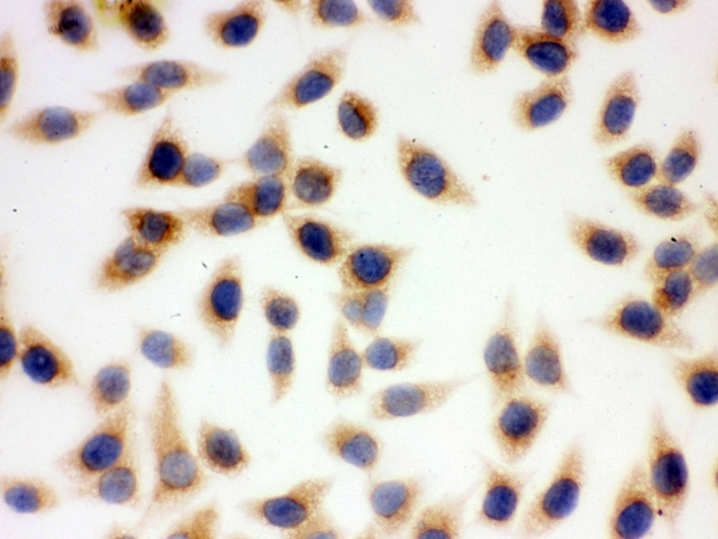 SOD2 / Mn SOD Antibody - IHC analysis of SOD2 using anti-SOD2 antibody. SOD2 was detected in immunocytochemical section of SMMC-7721 cell. Heat mediated antigen retrieval was performed in citrate buffer (pH6, epitope retrieval solution) for 20 mins. The tissue section was blocked with 10% goat serum. The tissue section was then incubated with 1µg/ml rabbit anti-SOD2 Antibody overnight at 4°C. Biotinylated goat anti-rabbit IgG was used as secondary antibody and incubated for 30 minutes at 37°C. The tissue section was developed using Strepavidin-Biotin-Complex (SABC) with DAB as the chromogen.