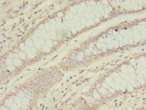 SOD2 / Mn SOD Antibody - Immunohistochemistry of paraffin-embedded human colon cancer using antibody at 1:100 dilution.  This image was taken for the unconjugated form of this product. Other forms have not been tested.