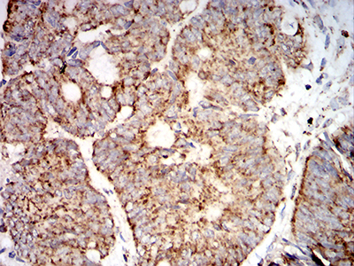 SOD2 / Mn SOD Antibody - Immunohistochemical analysis of paraffin-embedded rectum cancer tissues using SOD2 mouse mAb with DAB staining.