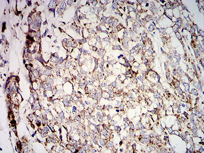 SOD2 / Mn SOD Antibody - Immunohistochemical analysis of paraffin-embedded breast cancer tissues using SOD2 mouse mAb with DAB staining.