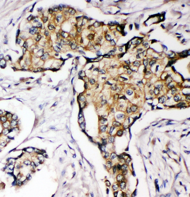 SOD3 Antibody - IHC analysis of SOD3 using anti-SOD3 antibody. SOD3 was detected in paraffin-embedded section of human mammary cancer tissue. Heat mediated antigen retrieval was performed in citrate buffer (pH6, epitope retrieval solution) for 20 mins. The tissue section was blocked with 10% goat serum. The tissue section was then incubated with 1µg/ml rabbit anti-SOD3 Antibody overnight at 4°C. Biotinylated goat anti-rabbit IgG was used as secondary antibody and incubated for 30 minutes at 37°C. The tissue section was developed using Strepavidin-Biotin-Complex (SABC) with DAB as the chromogen.