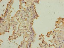 SOHLH2 Antibody - Immunohistochemistry of paraffin-embedded human breast cancer using SOHLH2 Antibody at dilution of 1:100