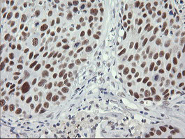 SOLO / SESTD1 Antibody - IHC of paraffin-embedded Carcinoma of Human lung tissue using anti-SESTD1 mouse monoclonal antibody.
