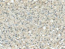 SORBS2 / ARGBP2 Antibody - Immunohistochemistry of paraffin-embedded Human liver cancer tissue  using SORBS2 Polyclonal Antibody at dilution of 1:120(×200)