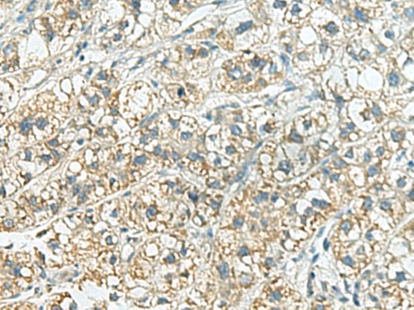 SORBS2 / ARGBP2 Antibody - Immunohistochemistry of paraffin-embedded Human liver cancer tissue  using SORBS2 Polyclonal Antibody at dilution of 1:160(×200)