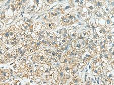 SORBS2 / ARGBP2 Antibody - Immunohistochemistry of paraffin-embedded Human liver cancer tissue  using SORBS2 Polyclonal Antibody at dilution of 1:160(×200)