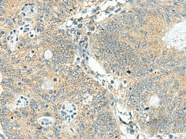 SORBS2 / ARGBP2 Antibody - Immunohistochemistry of paraffin-embedded Human colorectal cancer tissue  using SORBS2 Polyclonal Antibody at dilution of 1:160(×200)