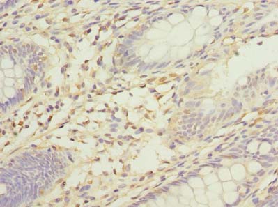 SORBS3 / Vinexin Antibody - Immunohistochemistry of paraffin-embedded human colon cancer using antibody at dilution of 1:100.