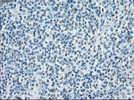 SORD / Sorbitol Dehydrogenase Antibody - IHC of paraffin-embedded Carcinoma of thyroid tissue using anti-SORD mouse monoclonal antibody. (Dilution 1:50).