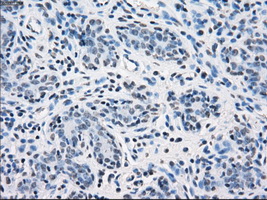SORD / Sorbitol Dehydrogenase Antibody - IHC of paraffin-embedded breast tissue using anti-SORD mouse monoclonal antibody. (Dilution 1:50).