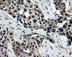 SORD / Sorbitol Dehydrogenase Antibody - IHC of paraffin-embedded Adenocarcinoma of breast tissue using anti-SORD mouse monoclonal antibody. (Dilution 1:50).