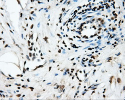 SORD / Sorbitol Dehydrogenase Antibody - IHC of paraffin-embedded Carcinoma of pancreas tissue using anti-SORD mouse monoclonal antibody. (Dilution 1:50).