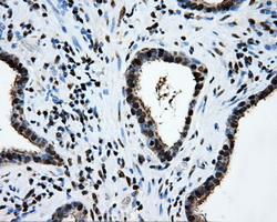 SORD / Sorbitol Dehydrogenase Antibody - IHC of paraffin-embedded Carcinoma of prostate tissue using anti-SORD mouse monoclonal antibody. (Dilution 1:50).