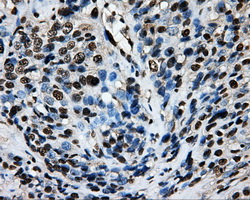 SORD / Sorbitol Dehydrogenase Antibody - IHC of paraffin-embedded Carcinoma of bladder tissue using anti-SORD mouse monoclonal antibody. (Dilution 1:50).