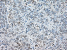 SORD / Sorbitol Dehydrogenase Antibody - Immunohistochemical staining of paraffin-embedded Adenocarcinoma of ovary tissue using anti-SORD mouse monoclonal antibody. (Dilution 1:50).