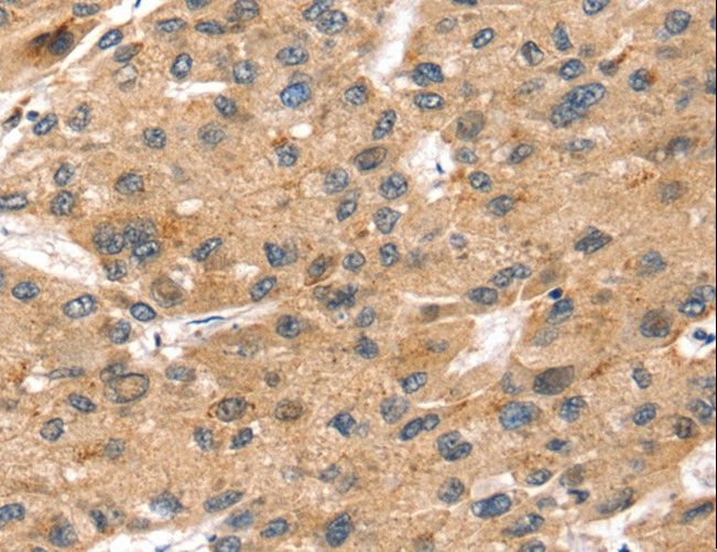 SORT1 / Sortilin Antibody - Immunohistochemistry of paraffin-embedded Human liver cancer using SORT1 Polyclonal Antibody at dilution of 1:35.