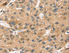 SORT1 / Sortilin Antibody - Immunohistochemistry of paraffin-embedded Human liver cancer using SORT1 Polyclonal Antibody at dilution of 1:35.