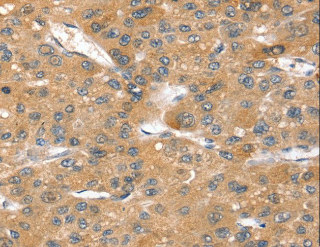 SORT1 / Sortilin Antibody - Immunohistochemistry of paraffin-embedded Human breast cancer using SORT1 Polyclonal Antibody at dilution of 1:40.