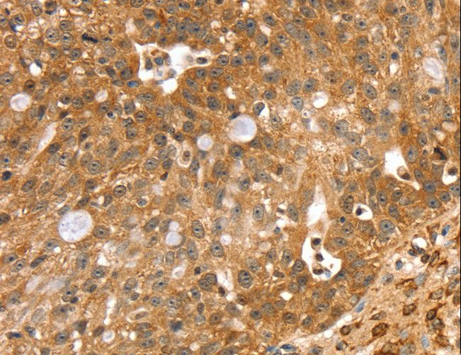 SORT1 / Sortilin Antibody - Immunohistochemistry of paraffin-embedded Human breast cancer using SORT1 Polyclonal Antibody at dilution of 1:40.
