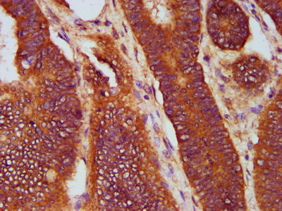 SOS1 Antibody - Immunohistochemistry Dilution at 1:400 and staining in paraffin-embedded human colon cancer performed on a Leica BondTM system. After dewaxing and hydration, antigen retrieval was mediated by high pressure in a citrate buffer (pH 6.0). Section was blocked with 10% normal Goat serum 30min at RT. Then primary antibody (1% BSA) was incubated at 4°C overnight. The primary is detected by a biotinylated Secondary antibody and visualized using an HRP conjugated SP system.