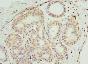 SOST / Sclerostin Antibody - Immunohistochemistry of paraffin-embedded human breast cancer using antibody at 1:100 dilution.