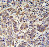 SOWAHC / ANKRD57 Antibody - ANKRD57 Antibody immunohistochemistry of formalin-fixed and paraffin-embedded human cervix carcinoma followed by peroxidase-conjugated secondary antibody and DAB staining.