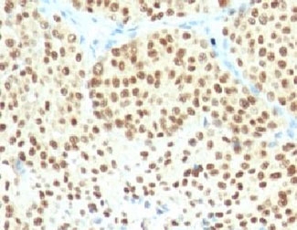 SOX10 Antibody - Formalin-fixed, paraffin-embedded human melanoma stained with SOX10 antibody (SPM607).  This image was taken for the unmodified form of this product. Other forms have not been tested.