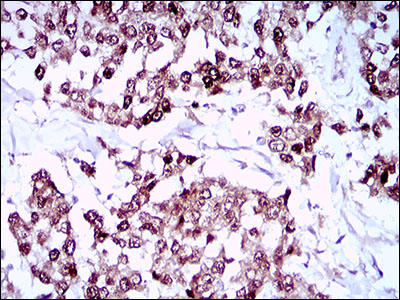 SOX10 Antibody - IHC of paraffin-embedded breast cancer tissues using SOX10 mouse monoclonal antibody with DAB staining.