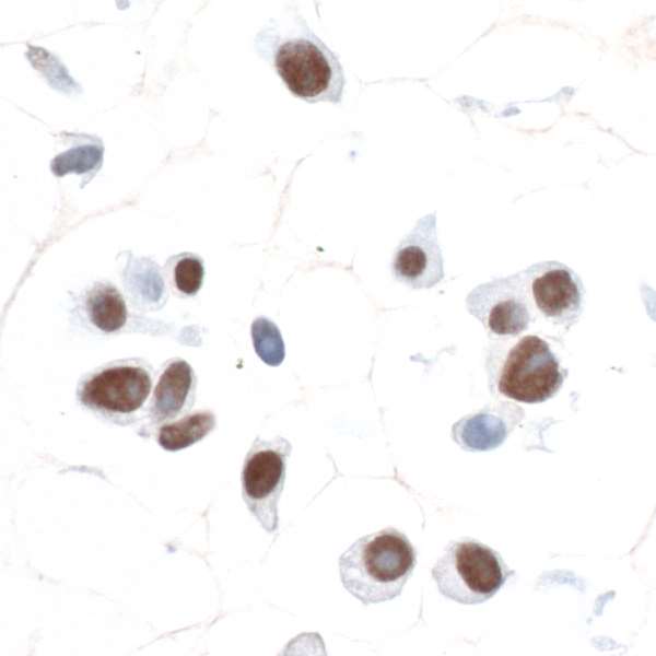 SOX10 Antibody - Detection of human SOX10 by immunocytochemistry. Sample: FFPE section of UACC-257 cells. Antibody: Rabbit anti-SOX10 antibody (A305-799A-M lot 1) used at 1:200. Secondary: HRP-conjugated goat anti-rabbit IgG (A120-501P). Substrate: DAB.