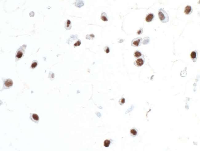 SOX10 Antibody - Detection of human SOX10 by immunocytochemistry. Sample: FFPE section of Malme-3M cells. Antibody: Rabbit anti-SOX10 antibody (A305-799A-M lot 1) used at 1:200. Secondary: HRP-conjugated goat anti-rabbit IgG (A120-501P). Substrate: DAB.
