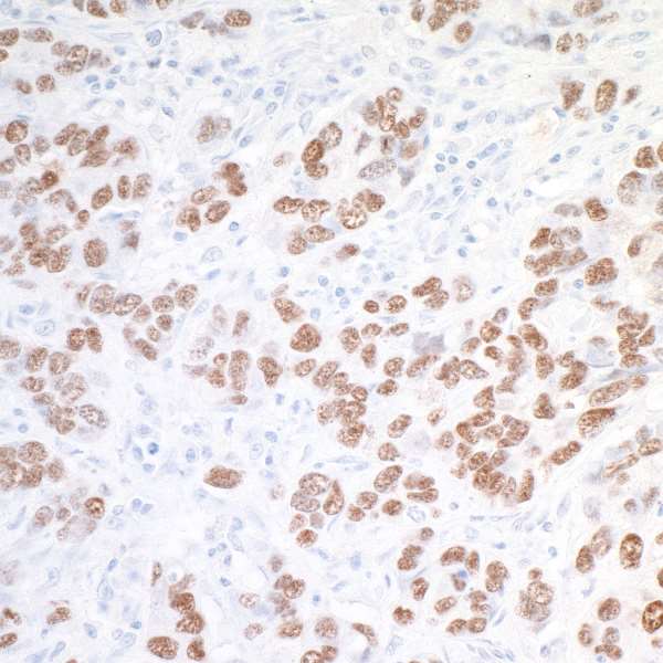 SOX10 Antibody - Detection of human SOX10 by immunohistochemistry. Sample: FFPE section of breast carcinoma. Antibody: Rabbit anti-SOX10 antibody (A305-799A-M lot 1) used at 1:200. Secondary: HRP-conjugated goat anti-rabbit IgG (A120-501P). Substrate: DAB.