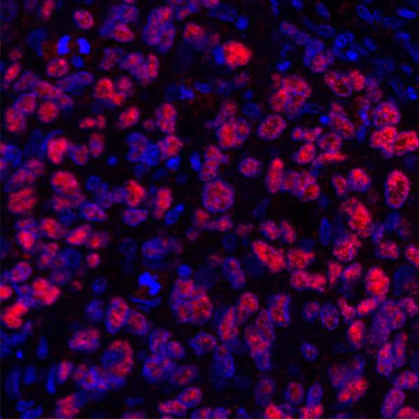 SOX10 Antibody - Detection of human SOX10 (red) by immunohistochemistry. Sample: FFPE section of human breast carcinoma. Antibody: Rabbit anti-SOX10 antibody (A305-799A-M lot 1) used at 1:250. Secondary: HRP-conjugated goat anti-rabbit IgG (A120-501P). Substrate: Opal™. Counterstain: DAPI (blue).