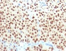 SOX10 Antibody - IHC testing of FFPE melanoma with SOX10 antibody (clone SBX10-1). Required HIER: boil sections in pH6 10mM citrate buffer for 10-20 minutes, followed by cooling at RT for 20 minutes, prior to staining.