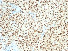 SOX10 Antibody - IHC testing of FFPE human melanoma with SOX-10 antibody (clone SOX10/1074). Required HIER: boil tissue sections in 10mM citrate buffer, pH 6, for 10-20 min followed by cooling at RT for 20 min.