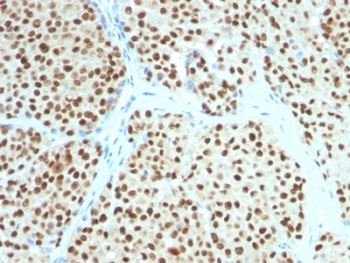 SOX10 Antibody - IHC testing of FFPE human melanoma with SOX10 antibody (clone SOX10/991). Required HIER: boil tissue sections in 10mM citrate buffer, pH 6, for 10-20 min followed by cooling at RT for 20 min.